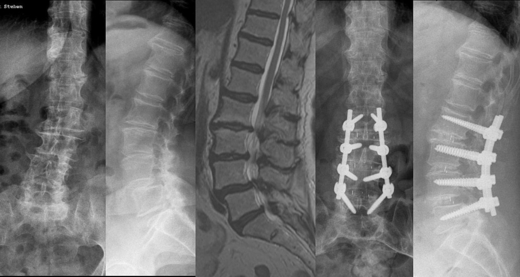 pickel an der wirbels�ule